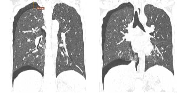 Kết quả CT phổi của BN có tràn khí màng phổi hai bên