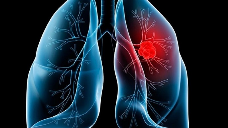 Khi các tế bào tại phổi bị loạn sản nhưng không dị sản sẽ hình thành nên u phổi lành tính