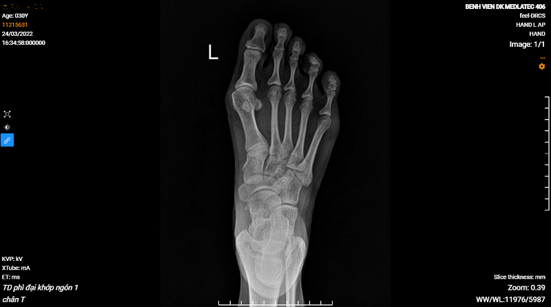 Hình ảnh chụp X-quang ngón 1 bàn chân trái của bệnh nhân bị lệch trục