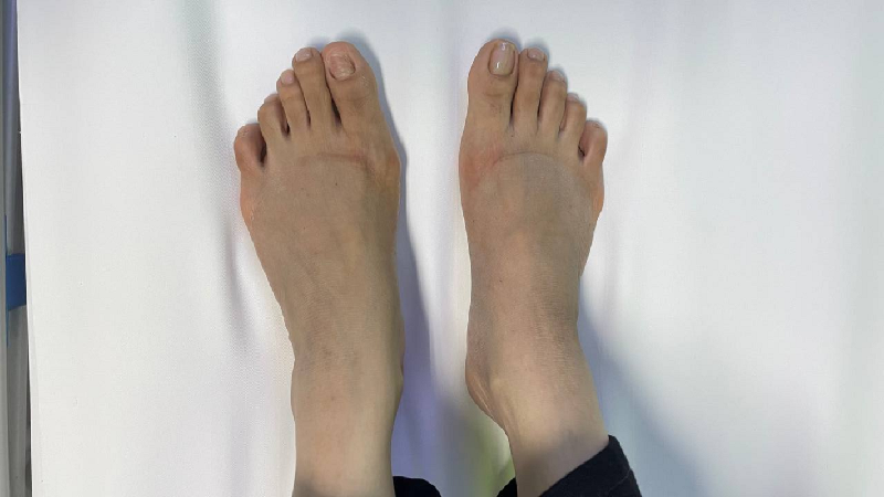 Hình ảnh ngón 1 chân trái của bệnh nhân