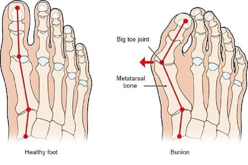 Hình minh họa so sánh giữa  bàn chân bình thường (bên trái) và bàn chân Bunion (bên phải)