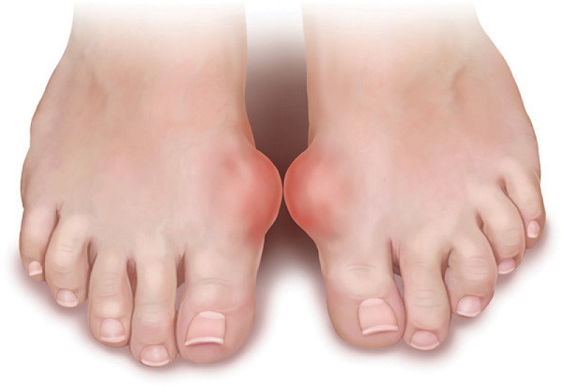 Cơn đau do Gout thường khởi phát ở khớp ngón cái chứ không phải ở đầu gối như bệnh giả Gout