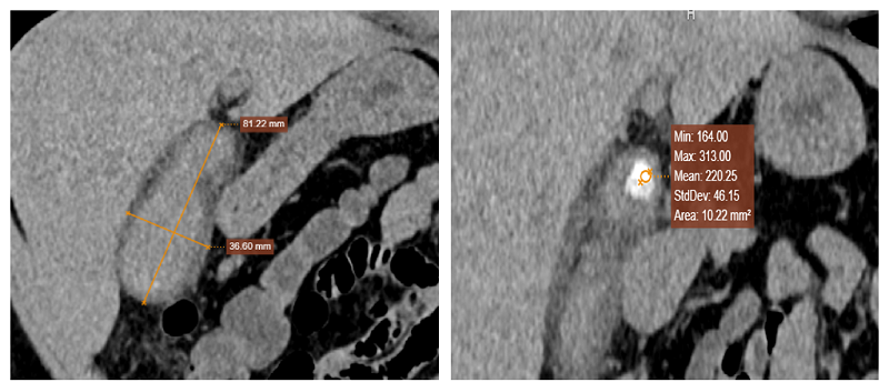 Phim chụp CT xác định hình ảnh theo dõi viêm túi mật mạn tính do sỏi lớn đúc khuôn trong lòng túi mật, đặc biệt sỏi rất cứng ở cổ túi mật