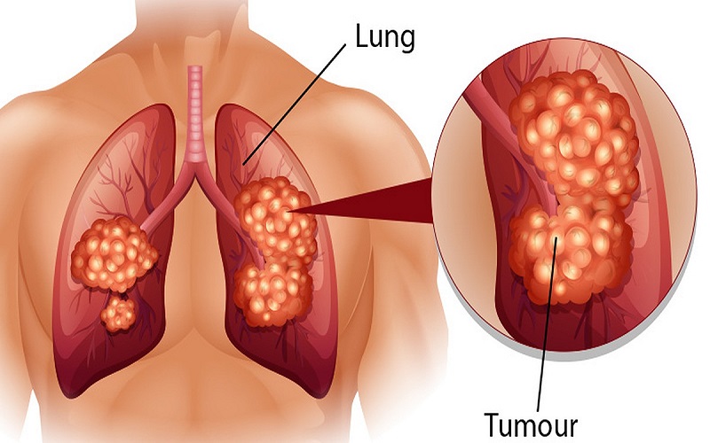 Ung thư phổi giai đoạn đầu biểu hiện rất "nghèo nàn" đến khi phát hiện bệnh đã trở nặng
