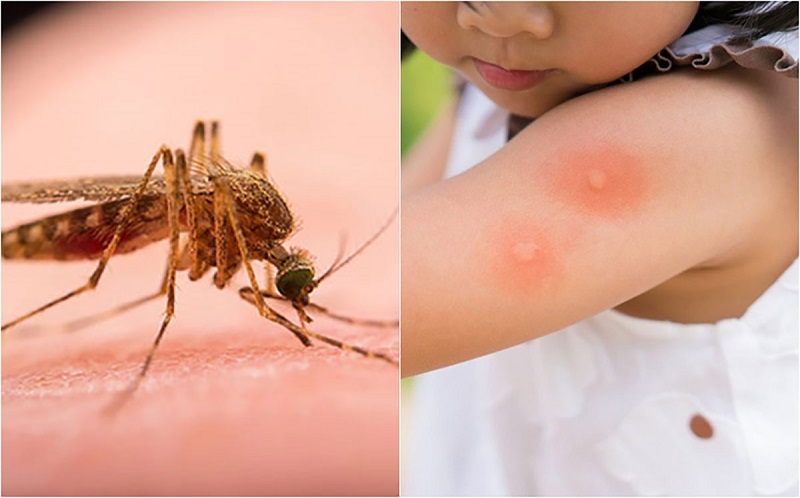Muỗi đốt gây sốt xuất huyết Dengue 