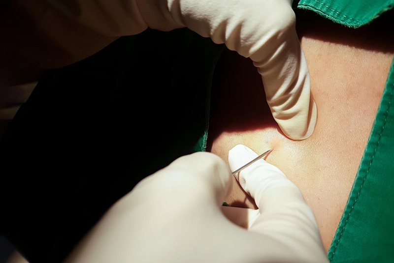 Gây tê ngoài màng cứng giúp bệnh nhân cắt trĩ giảm đau trong suốt quá trình mổ