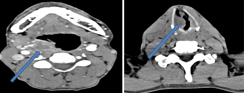Chụp CT vùng cổ cho chẩn đoán u hạ họng (hình ảnh bên trái) và u hạ họng lan vào thanh quản (hình ảnh bên phải)