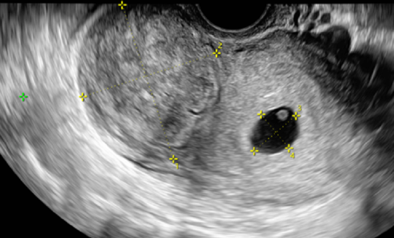 Trên hình ảnh siêu âm chẩn đoán xác định thai 5 tuần trong buồng tử cung/ U xơ cơ tử cung