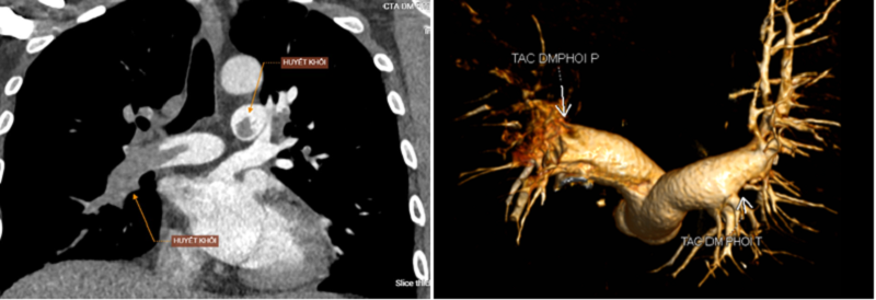 Hình ảnh huyết khối lan tỏa trong động mạch phổi phải và động mạch phổi trái được ghi nhận trên phim chụp MSCT của bệnh nhân