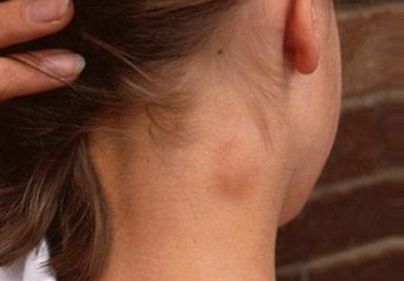Nguyên nhân nào gây hiện tượng trẻ nổi hạch ở phía sau tai?