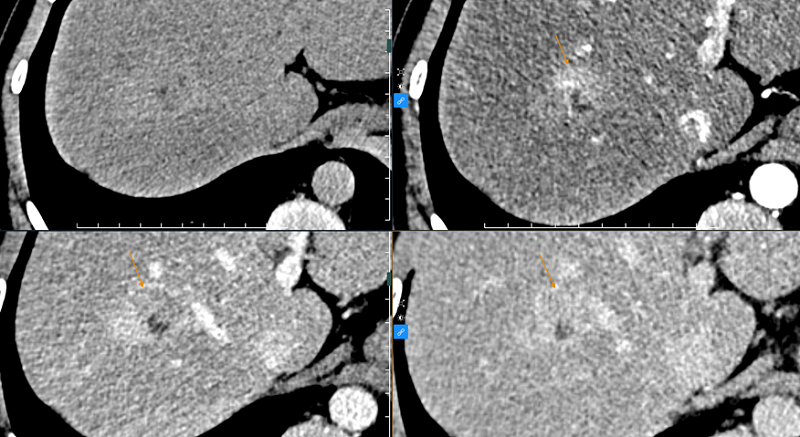 Hình ảnh khối u trên phim chụp cắt lớp vi tính của bệnh nhân H.