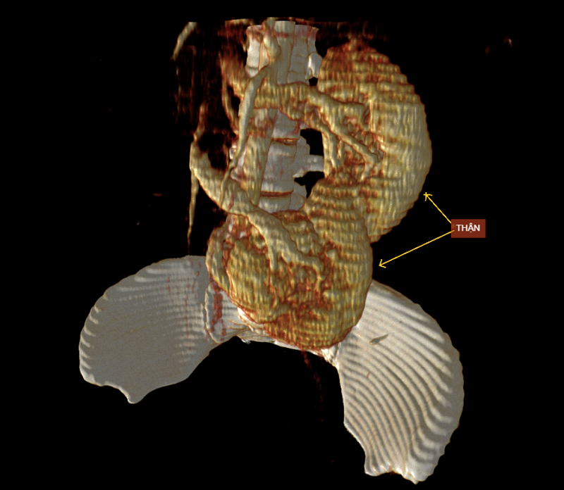 Bệnh nhân có chẩn đoán xác định dự trên phim chụp CT ổ bụng xác định bất thường giải phẫu thân Sigma bên trái