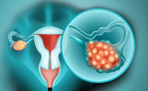     Hình 1. Ung thư buồng trứng (Nguồn: Women's Cancer Initiative Tata Hospital. About Ovarian Cancer, 2020)