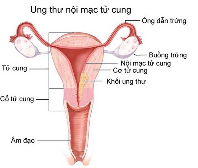 Ung thư nội mạc tử cung (Nguồn: Endometrial cancer, Mayo Clinic, May 20, 2021).