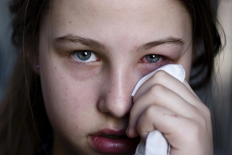 Viêm củng mạc thường gây đau trong mắt rất nghiêm trọng