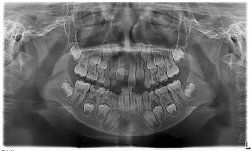 Hình ảnh chụp Panorama răng mọc thừa hàm trên của bệnh nhân 