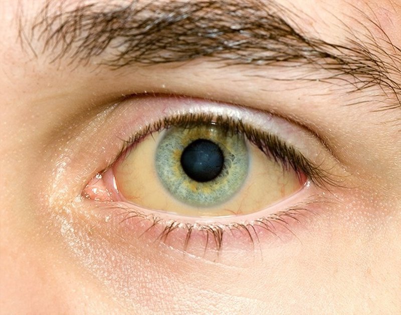 Vàng da, vàng mắt,... có thể là biểu hiện của bệnh viêm gan B nên cần đi khám ngay