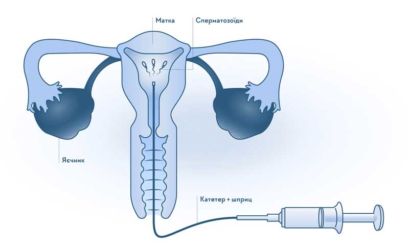 Bơm tinh trùng vào buồng tử cung IUI được chỉ định trong 1 số trường hợp
