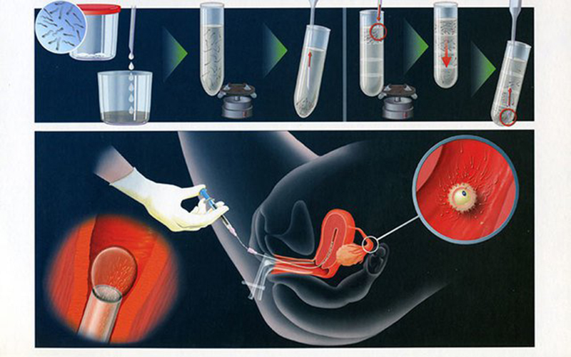 Phương pháp bơm tinh trùng vào buồng tử cung (IUI)