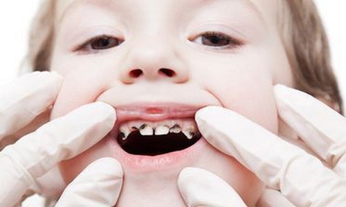 Hình ảnh minh họa rối loạn mọc răng vĩnh viễn ở trẻ em