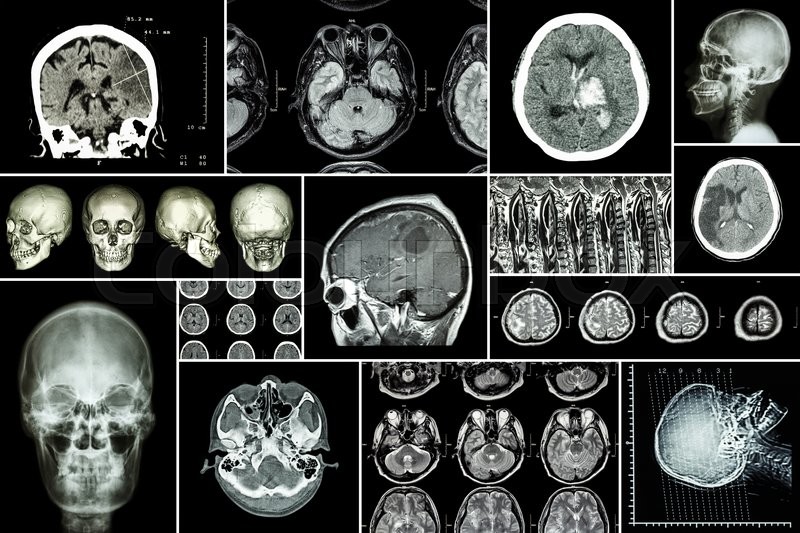 Chụp CT não sẽ giúp thu về hình ảnh của toàn bộ vùng não và xương đầu