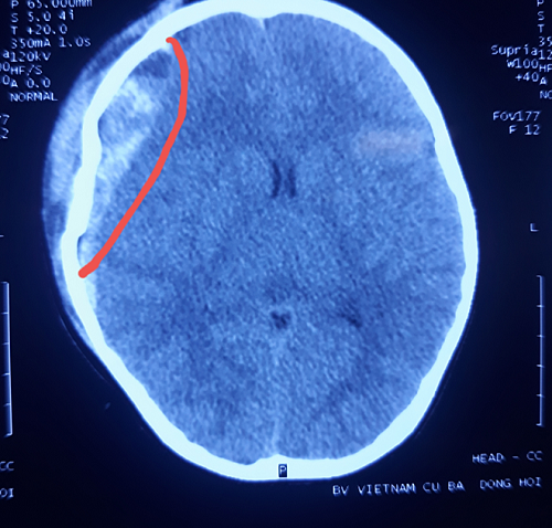 Chụp cắt lớp não tại MEDLATEC an toàn, nhanh chóng, chính xác
