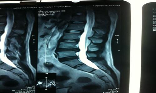 Hình ảnh rõ nét về cột sống thu được sau khi chụp cộng hưởng từ MRI