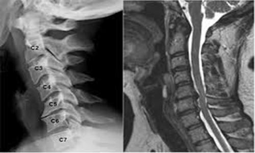 Hình ảnh thu lại được từ bệnh nhân chụp cộng hưởng từ cột sống thắt lưng