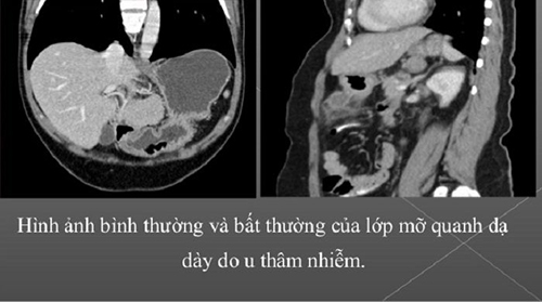 Chụp CT dạ dày giúp chẩn đoán sớm các bệnh lý ở dạ dày