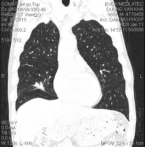 <a href='https://medlatec.vn/tin-tuc/truoc-khi-chup-ct-phoi-nhat-dinh-ban-phai-biet-dieu-nay-s154-n18748'  title ='chụp CT phổi'>chụp CT phổi</a> mang lại rất nhiều ý nghĩa trong y học ngày nay 