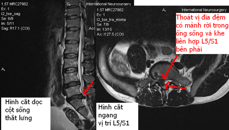Hình ảnh chụp cột sống thắt lưng bằng MRI