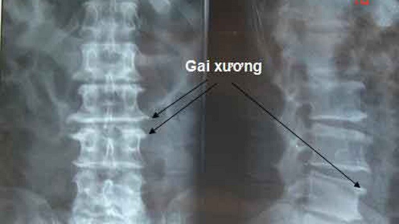 Hình ảnh chụp X-quang cột sống