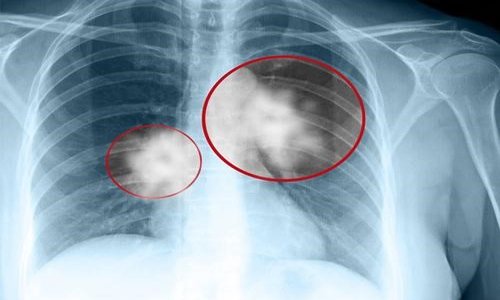Hình ảnh chụp X-quang tim phổi