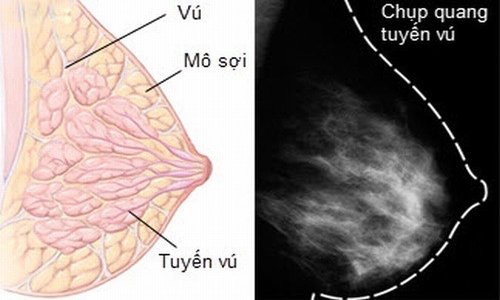 Chụp X-quang vú giúp kiểm tra những bất thường ở vú
