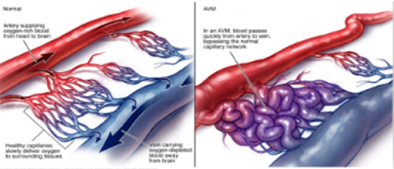 Hình ảnh dị dạng động tĩnh mạch thận (AVM) 