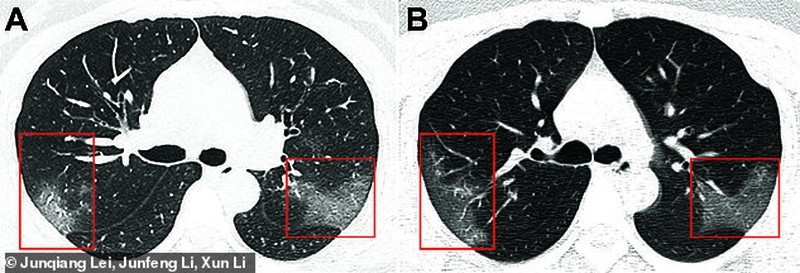 Đốm trắng cho thấy chất lỏng tích tụ trong phổi bệnh nhân nhiễm virus Corona