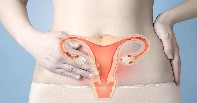 Bơm tinh trùng vào tử cung IUI dành cho phụ nữ bị vô sinh không rõ nguyên nhân