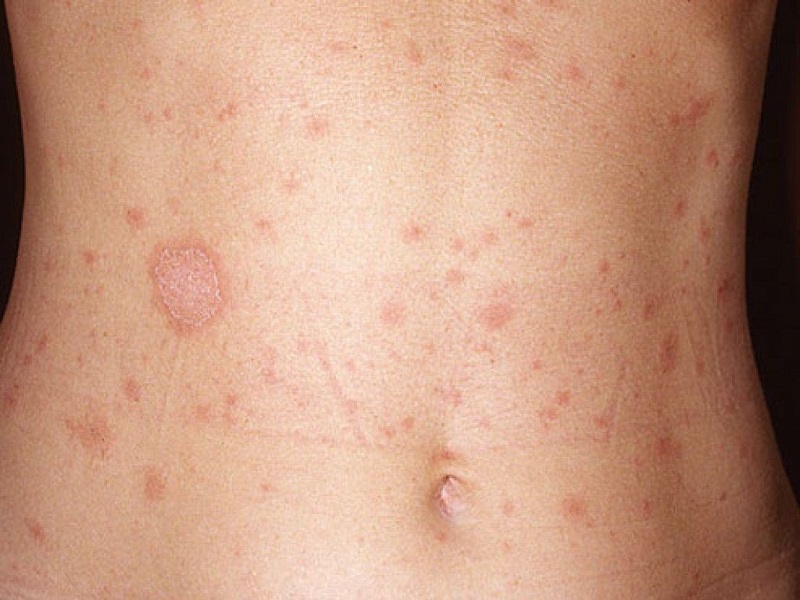 Phát ban đỏ ngoài da cần cảnh giác giai đoạn đầu của người nhiễm HIV