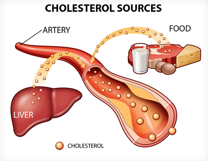 Rối loạn chuyển hóa cholesterol máu
