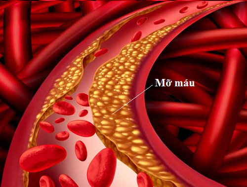 hình ảnh minh họa mỡ dư thừa trong máu hay còn gọi là máu nhiễm mỡ