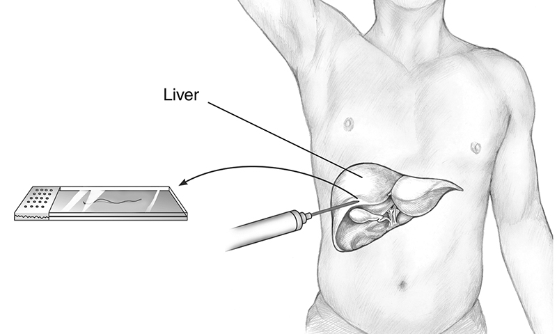 Kỹ thuật sinh thiết gan trong chẩn đoán gan nhiễm mỡ