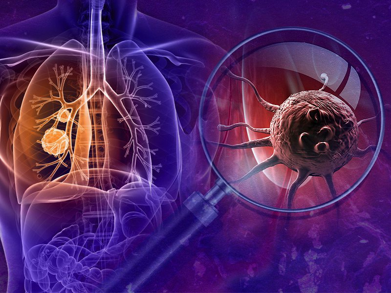 Ung thư phổi là căn bệnh ác tính có tỷ lệ tử vong cao