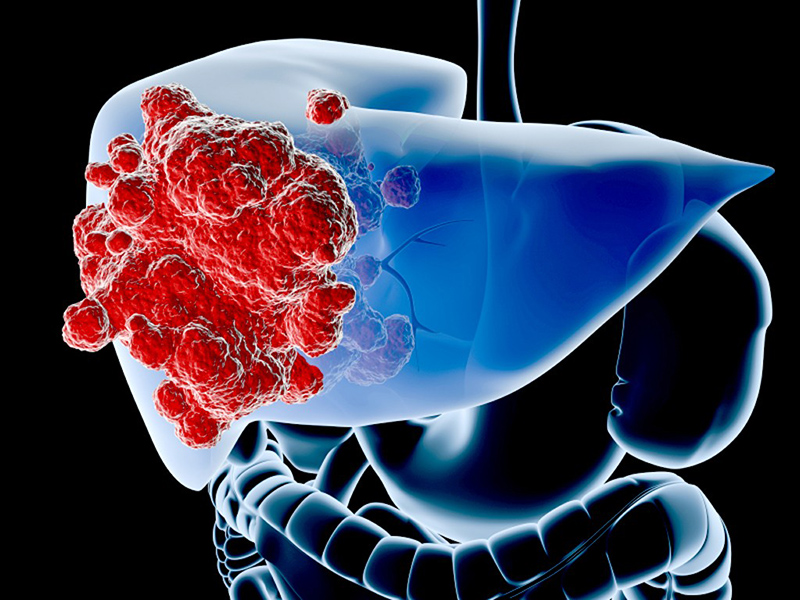 Gan nhiễm mỡ có thể phát triển thành ung thư gan nếu không được điều trị kịp thời