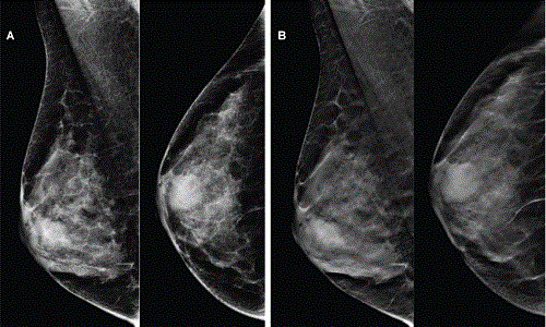Tầm soát, chẩn đoán ung thư vú bằng kỹ thuật chụp X-quang tuyến vú tại MEDLATEC