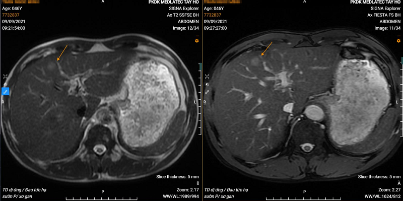 Hình ảnh khối u gan trái trên phim chụp MRI của bệnh nhân 