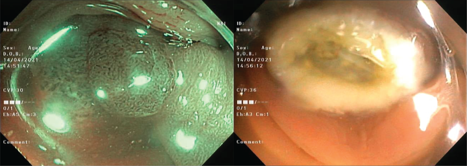 Hình ảnh polyp đại tràng phát hiện bằng ánh sáng dải tần hẹp (NBI) và hình ảnh cắt polyp qua nội soi bằng snare (ảnh theo thứ tự từ trái qua phải)