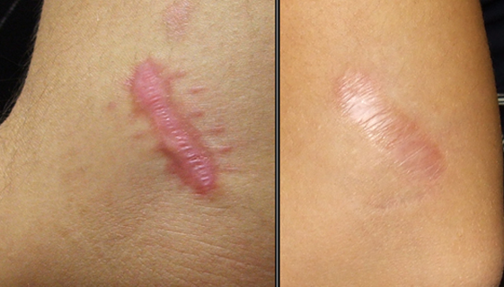 Hình ảnh sẹo lồi trước và sau điều trị