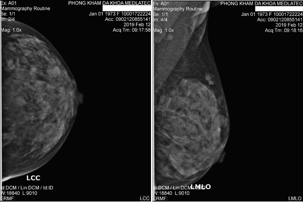 X-quang vú giúp phát hiện ung thư vú