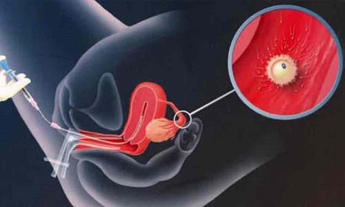 Phương pháp bơm tinh trùng vào buồng tử cung tại MEDLATEC 
