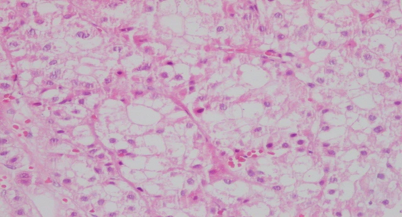 Hình ảnh giải phẫu bệnh kết luận ung thư biểu mô tế bào gan (HCC)